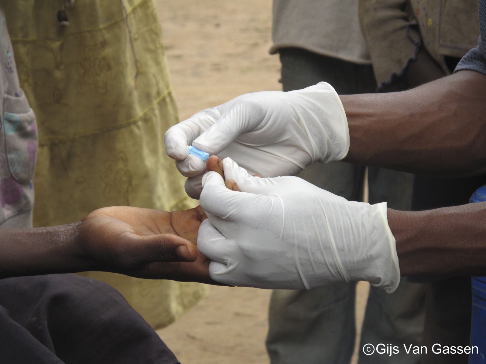 손 끝에서 피를 채혈하는 간단한 방법으로 말라리아를 신속하게 진단하고 있다.