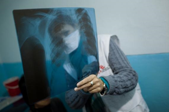 결핵이 사나운 위세를 떨치고 있는 키르키즈스탄의 한 병원에서 국경없는의사회 의사가 환자의 X-ray를 검토하고 있다. 잘못된 진단 및 치료로 결핵이 퍼지지 않도록 약제내성 결핵(DR-TB)을 정확히 제때 진단하려면 환자의 약제 감수성 검사가 꼭 필요하다. ©Vincent Tremeau