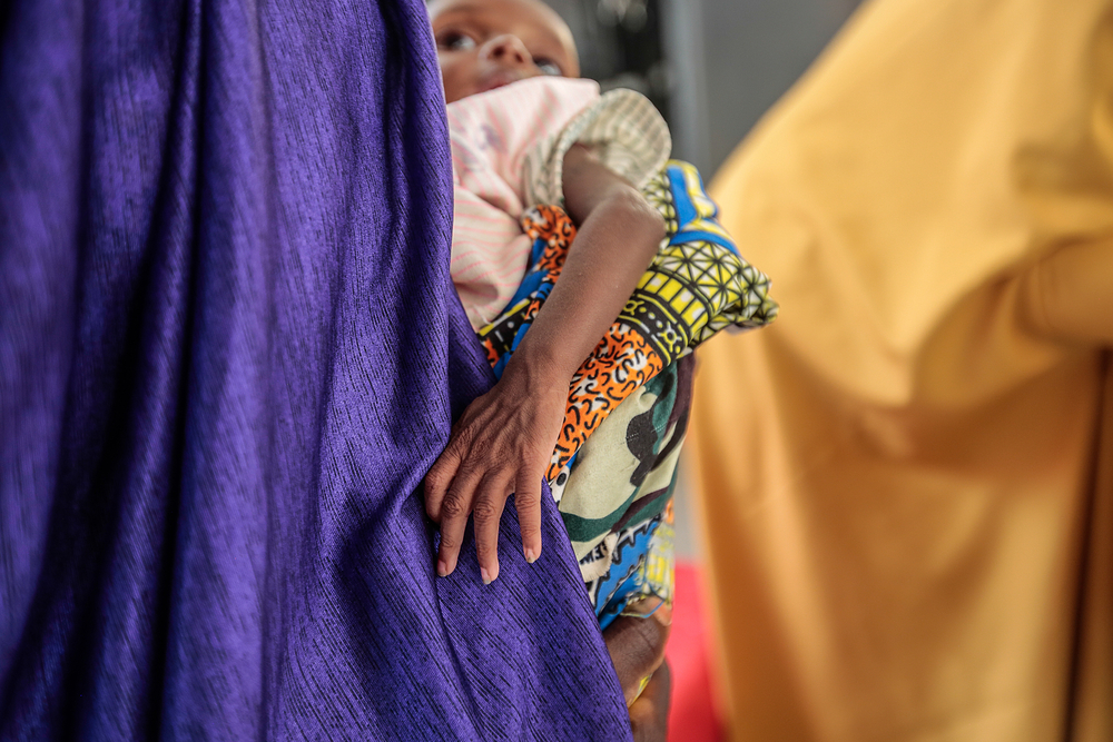 중증 급성 영양실조 아동의 팔. 나이지리아 카치나주, 2022년 6월. ©George Osodi  